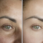 Before and after results of HydraFacial treatment at Reimagine Beauty Lancaster Med Spa.