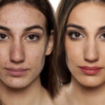 Before and after results of Acne Bootcamp treatment at Reimagine Beauty Lancaster Med Spa.