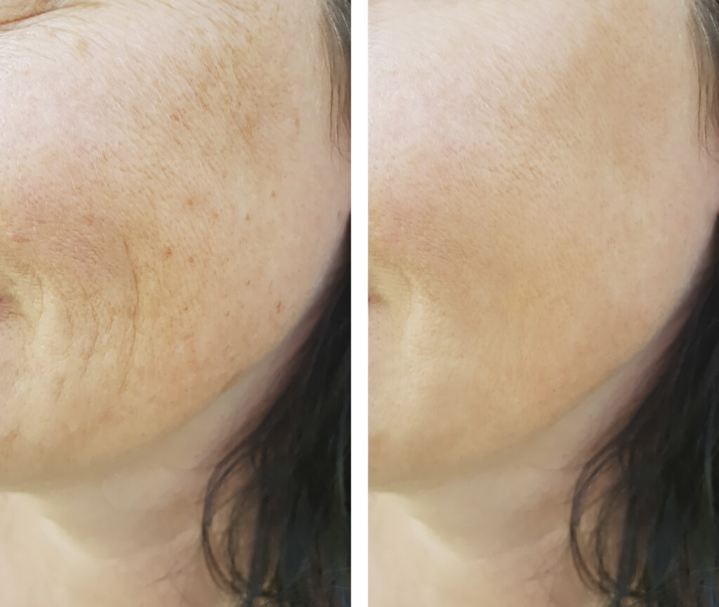 Before and after results of HydraFacial treatment at Reimagine Beauty Lancaster Med Spa.