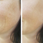 Before and after results of HydraFacial treatment at Reimagine Beauty Lancaster Med Spa.