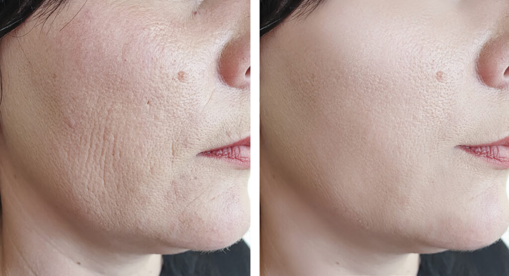 Reimagine Beauty Lancaster County Med Spa Dermal Fillers