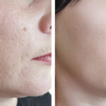 Reimagine Beauty Lancaster County Med Spa Dermal Fillers