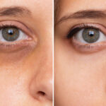 Reimagine Beauty Lancaster Med Spa Before and After Dermal FIllers