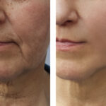 Reimagine Beauty Lancaster County Med Spa Before and After